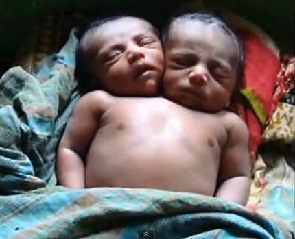 Two 2 headed Mutated baby deformed radiation radioactive fallout depeted Uranium Fukushima fallout India World wide