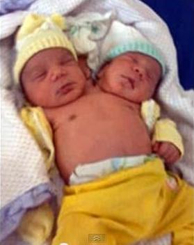 radiation mutation 2 headed baby nuclear fallout Fukushima Iraq Chernobyl genetic damage to chromosomes