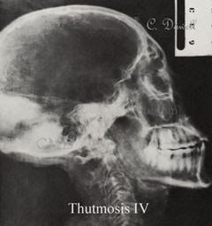 Image of Thutmosis IV  X-ray of mummies skull showing malformation photo collection of Colette Dowell